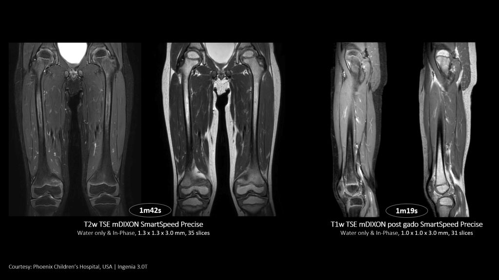 SmartSpeed Precise Long bone imaging. Shorter scan time with high image quality.