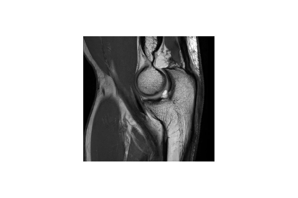 Sagittal PDw TSE