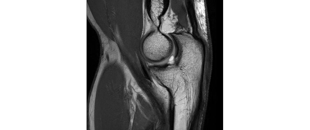 Sagittal PDw TSE