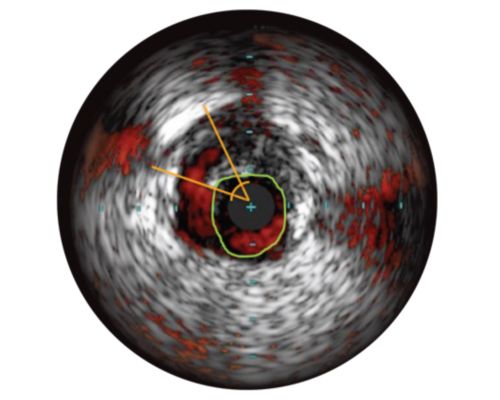 Assessment of edge dissection