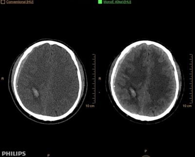 Philips IQon Spectral CT — Клинические исследования на IQon Spectral CT — фото 2