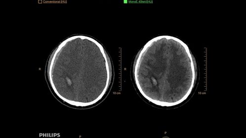 Brain Subdural Hematoma