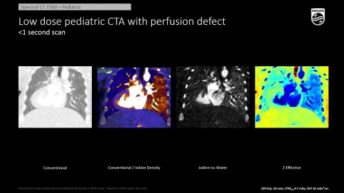 CT Spectral 7500 Pediatric Chest Perf Def
