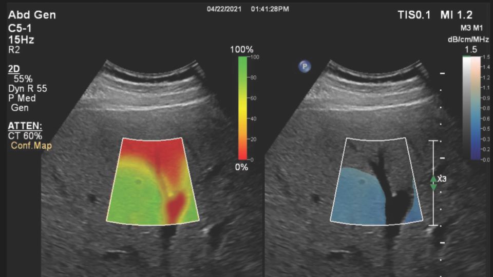 Attenuation confidence map