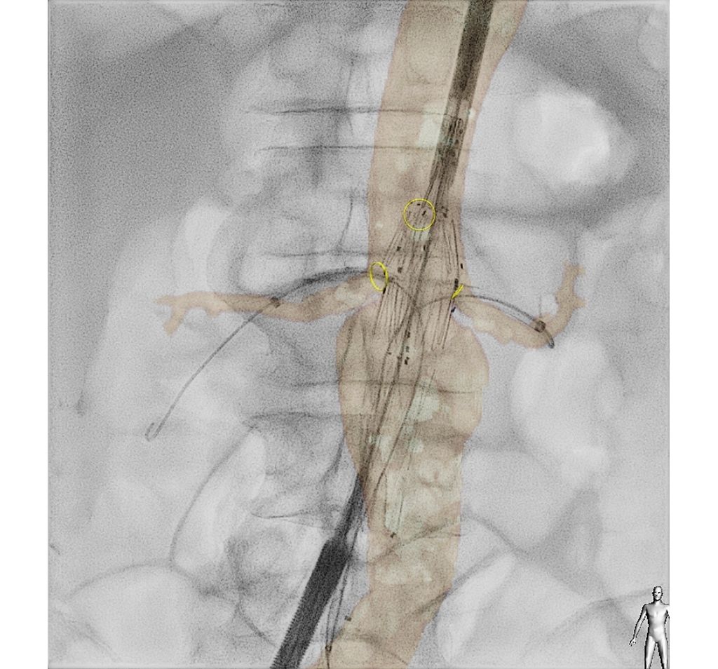 VesselNavigator Tecnología de fusión de imágenes 3D para procedimientos endovasculares