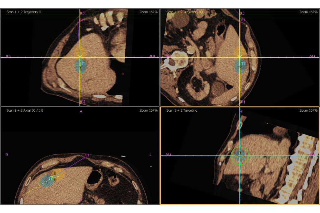 CT Only Navigation with Planned Ablation Zone