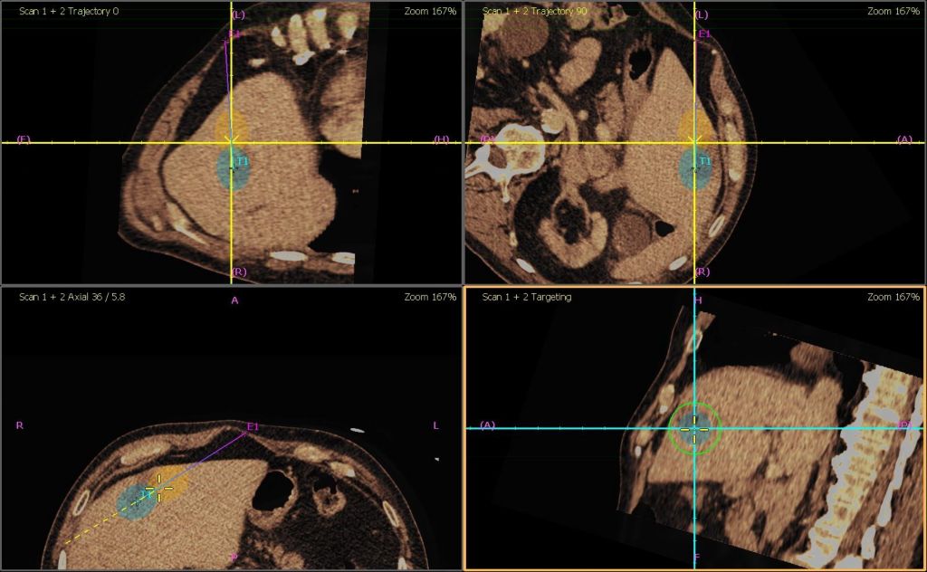 CT Only Navigation with Planned Ablation Zone