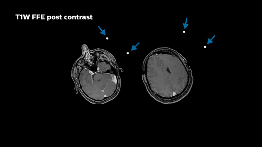 T1W FFE post contrast