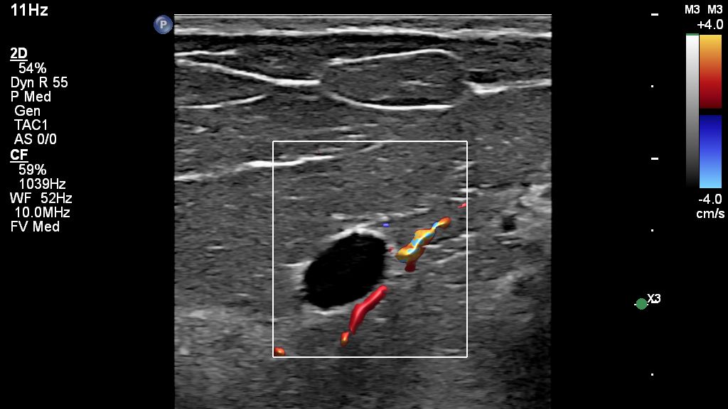EPIQ Elite Elevate with L26-8 probe for Breast with Superficial Cyst