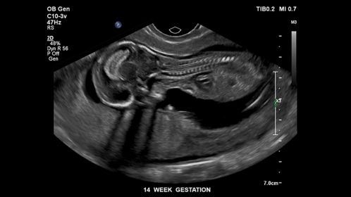Fetus at 14 weeks gestation