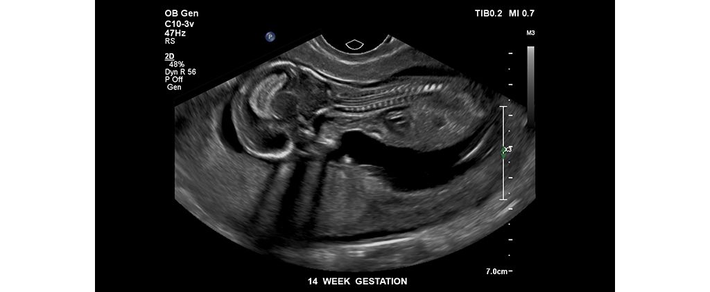 Fetus at 14 weeks gestation