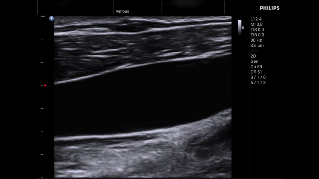 L12-4 Jugular Vein