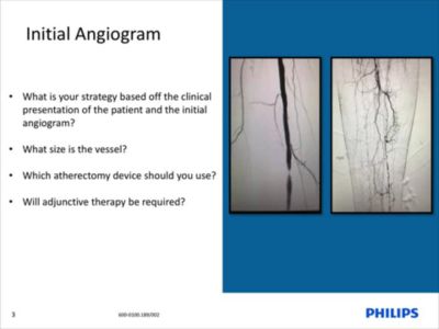 Phoenix with IVUS Case Review Dr. Griffin⁵,⁶