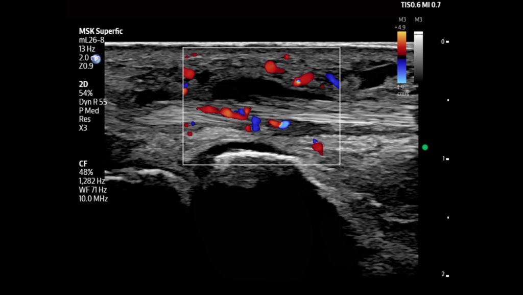 Superficial wrist shown with color flow Doppler using mL26-8 transducer.