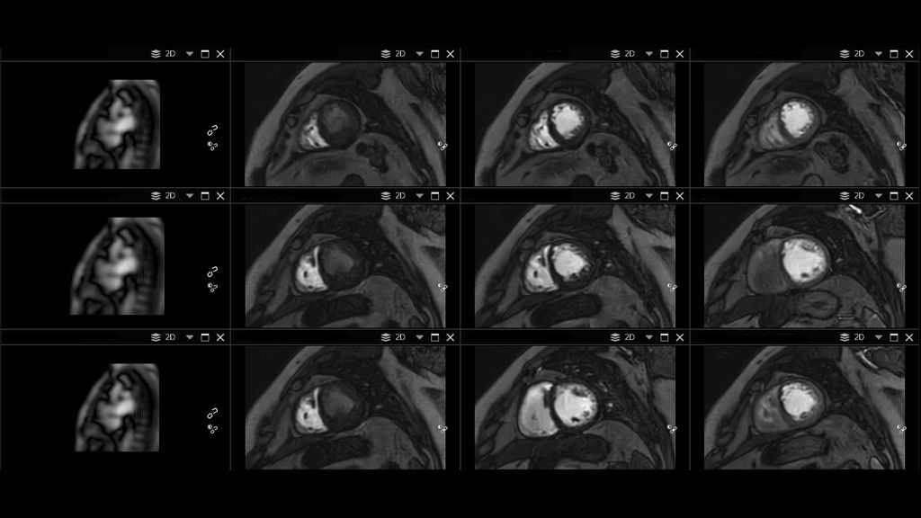 CardiacQuant Perfusion data processed with Circle CVI post processing software
