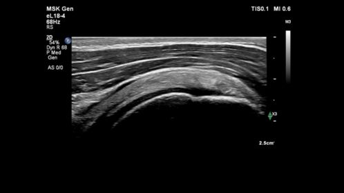 Shoulder supraspinatus tendon with eL18-4 transducer