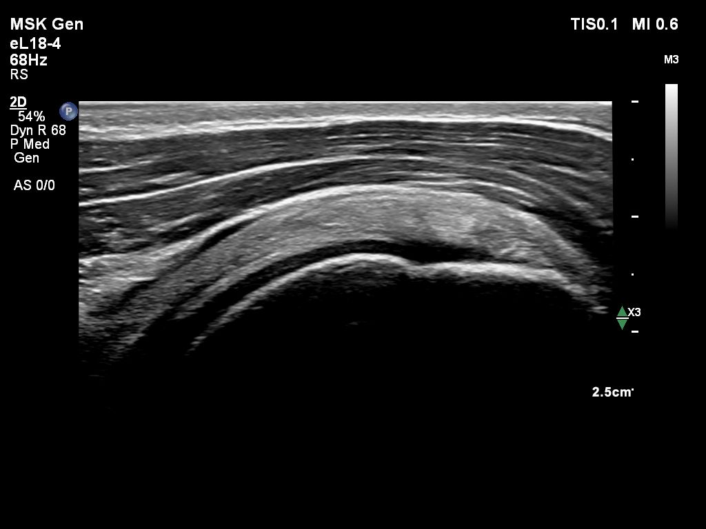 Shoulder supraspinatus tendon with eL18-4 transducer