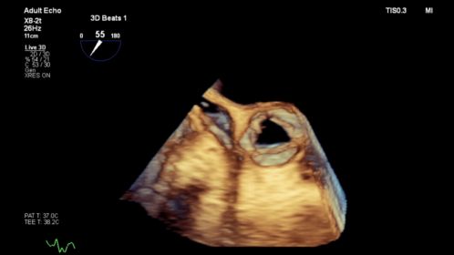 Affiniti CVx X8-2t Live 3D SAX Aortic Valve