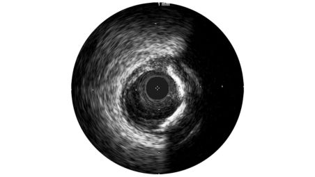 IVUS helps with disease assessment 