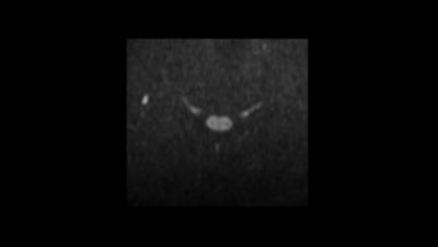Philips - Zoom Diffusion - Spine MR clinical application - Philips