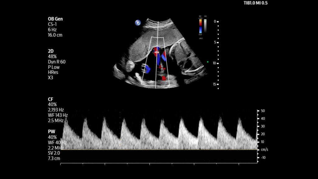 Umbilical cord shown with pulsed wave and color flow Doppler using C5-1 transducer.
