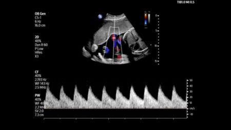 Umbilical cord shown with pulsed wave and color flow Doppler using C5-1 transducer.