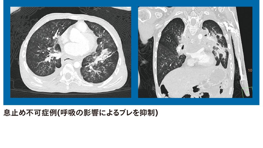 息止め不可症例(呼吸の影響によるブレを抑制)