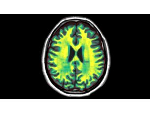 3D Smart Quant Neuro MR Clinical applications