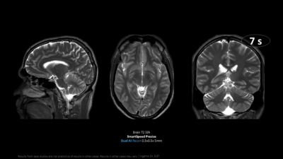 Philips SmartSpeed Precise Brain T2 MRI scans showing high-resolution images acquired in seven seconds