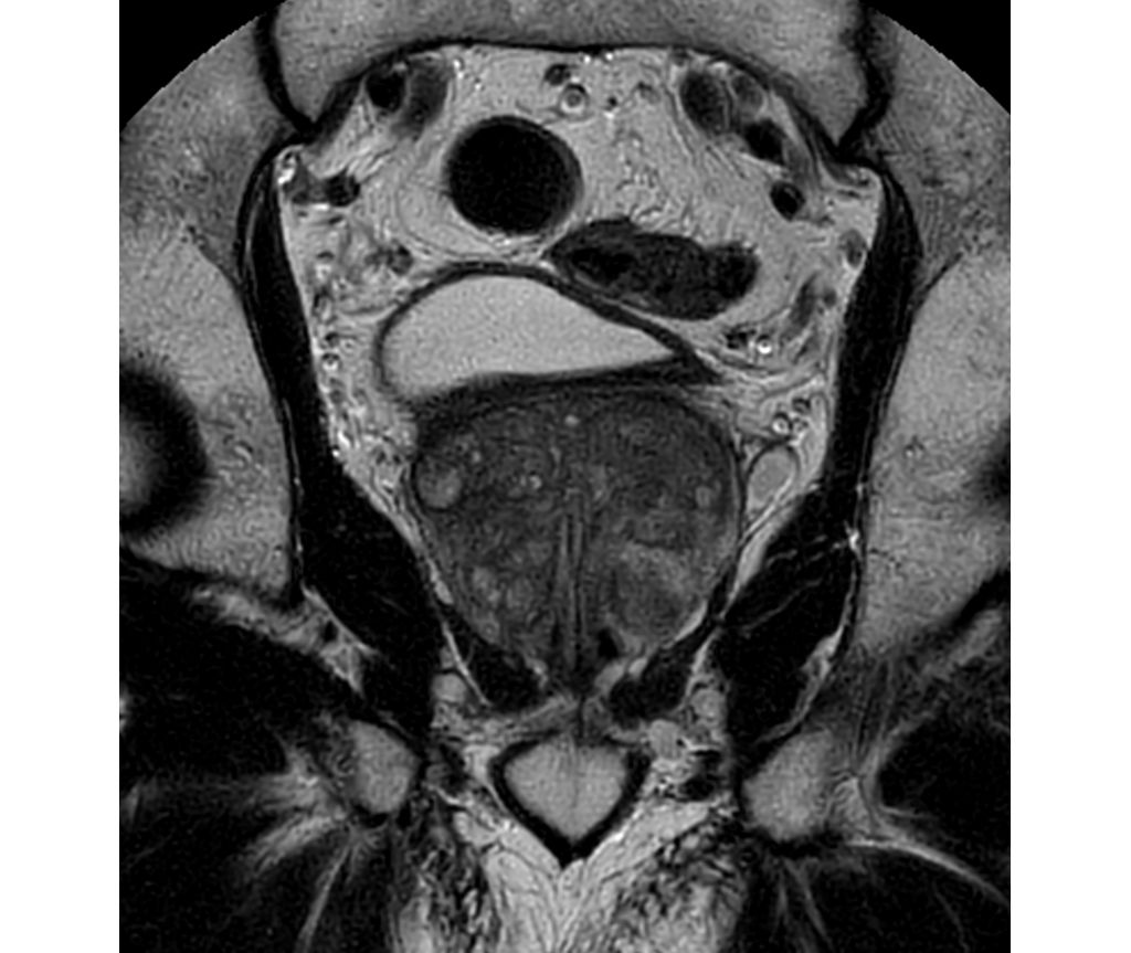 MultiVane XD - Coronal T2w TSE
