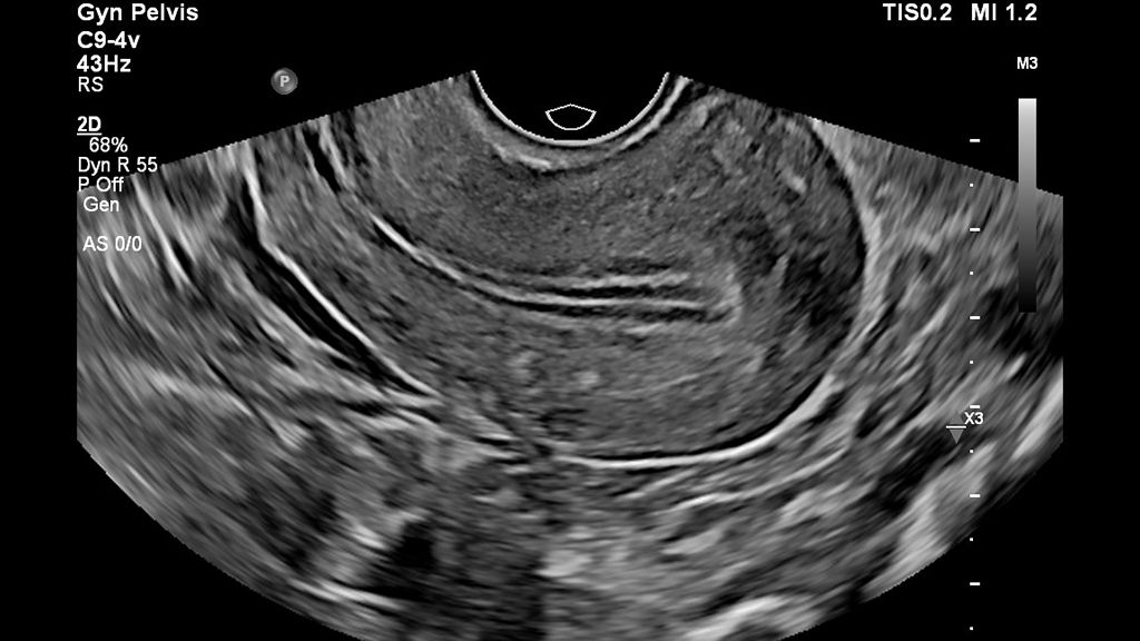 Image of pelvis using C9-4v transducer