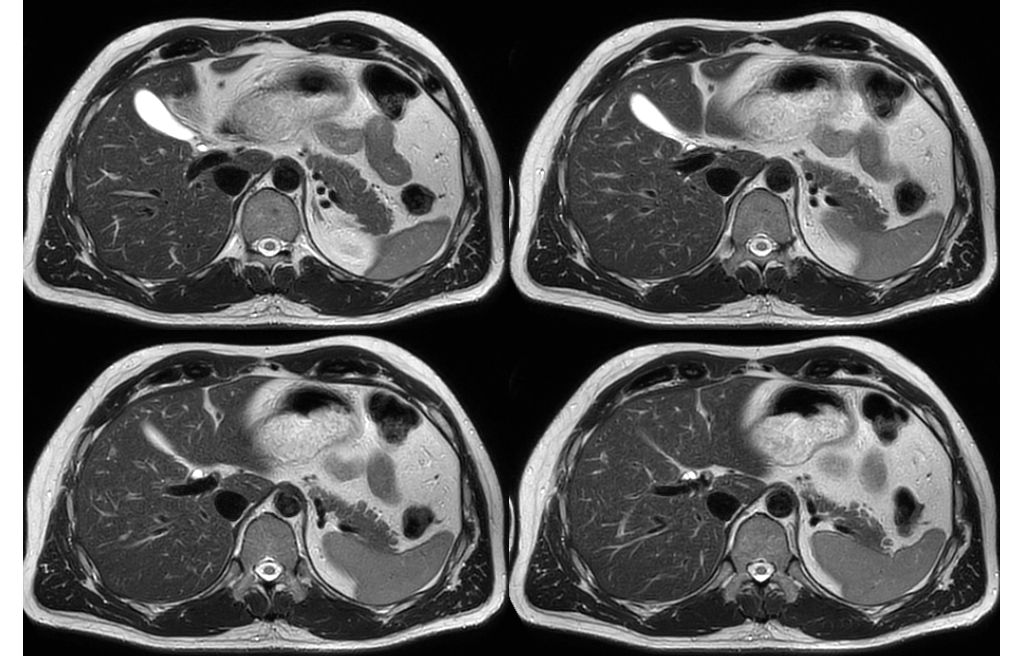 Multivane XD - Abdomen    
