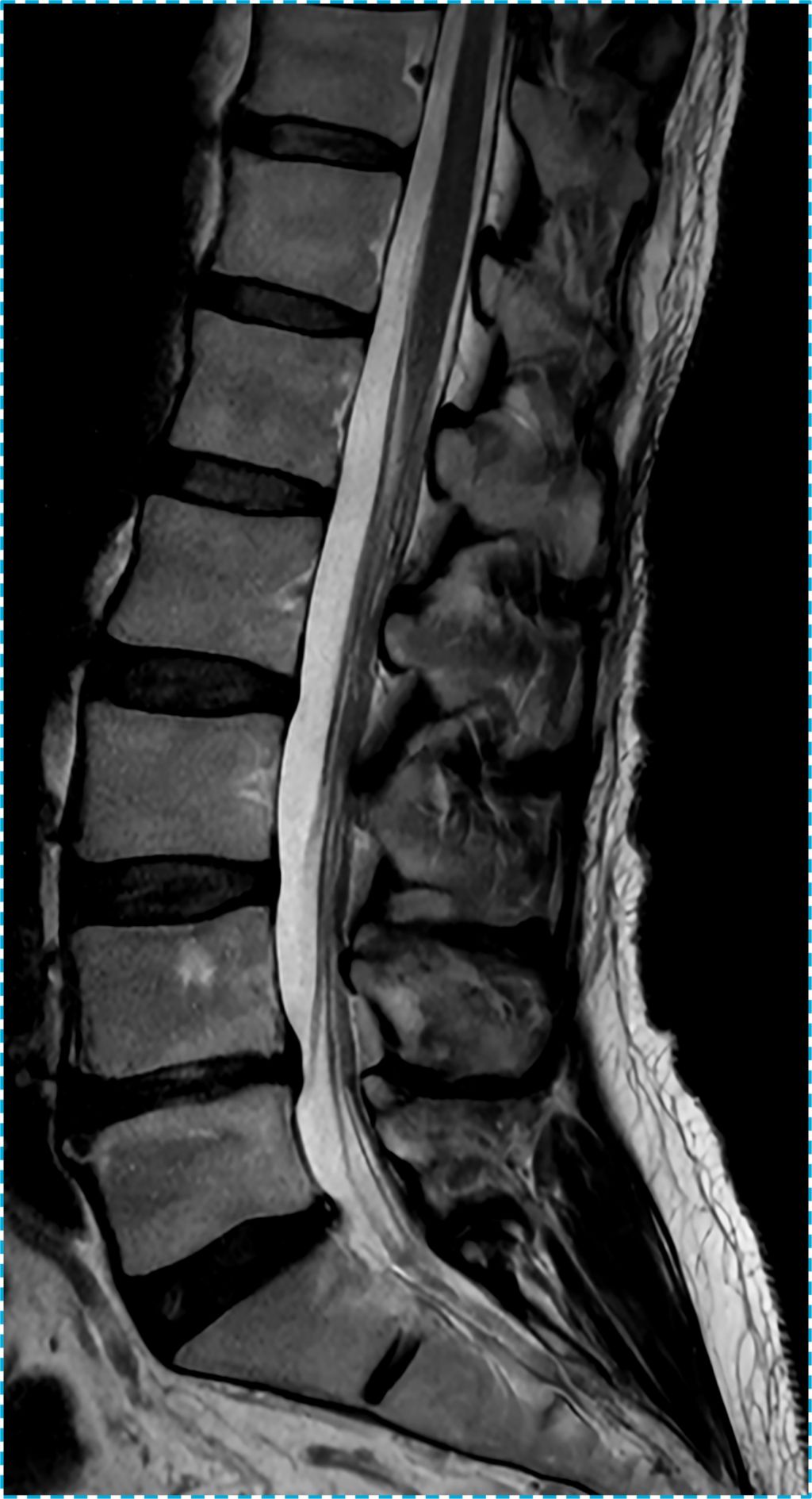 L Spine T2 TSE