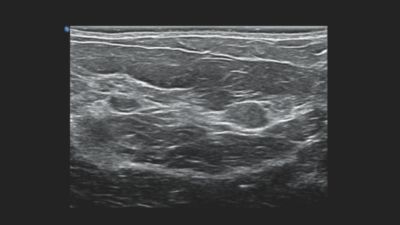 多発性線維腺腫を伴う乳房組織