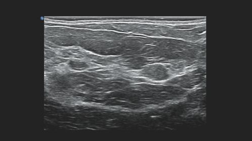 Breast Tissue with Multiple Fibroadenomas