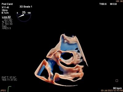 Pediatrisch 3d beeld van hartechografie