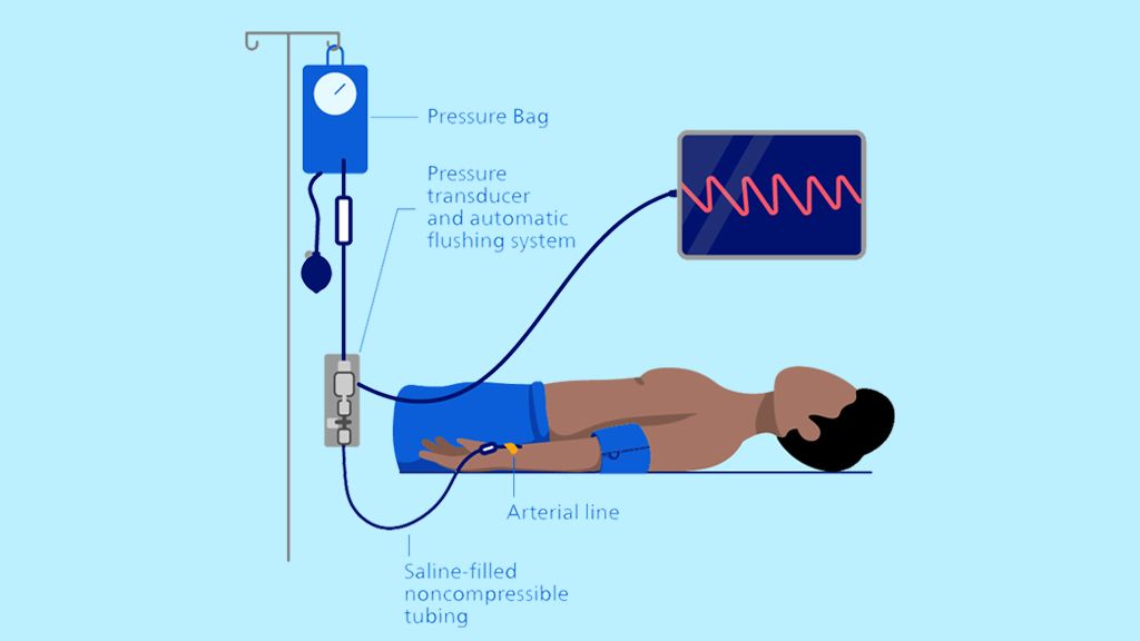 Intra-arterial line illustration