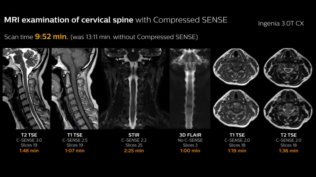 MRI of cervical spine with Compressed SENSE