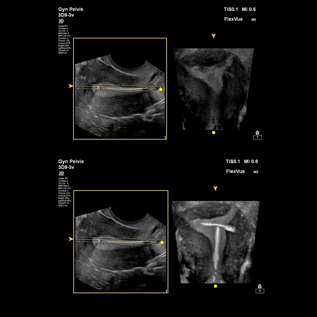  Uterine ultrasound image showing IUD in coronal plane