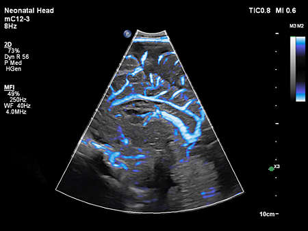 mC12-3 Neonatal Head MFI
