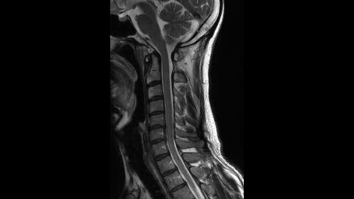 Sagittal T2w TSE 