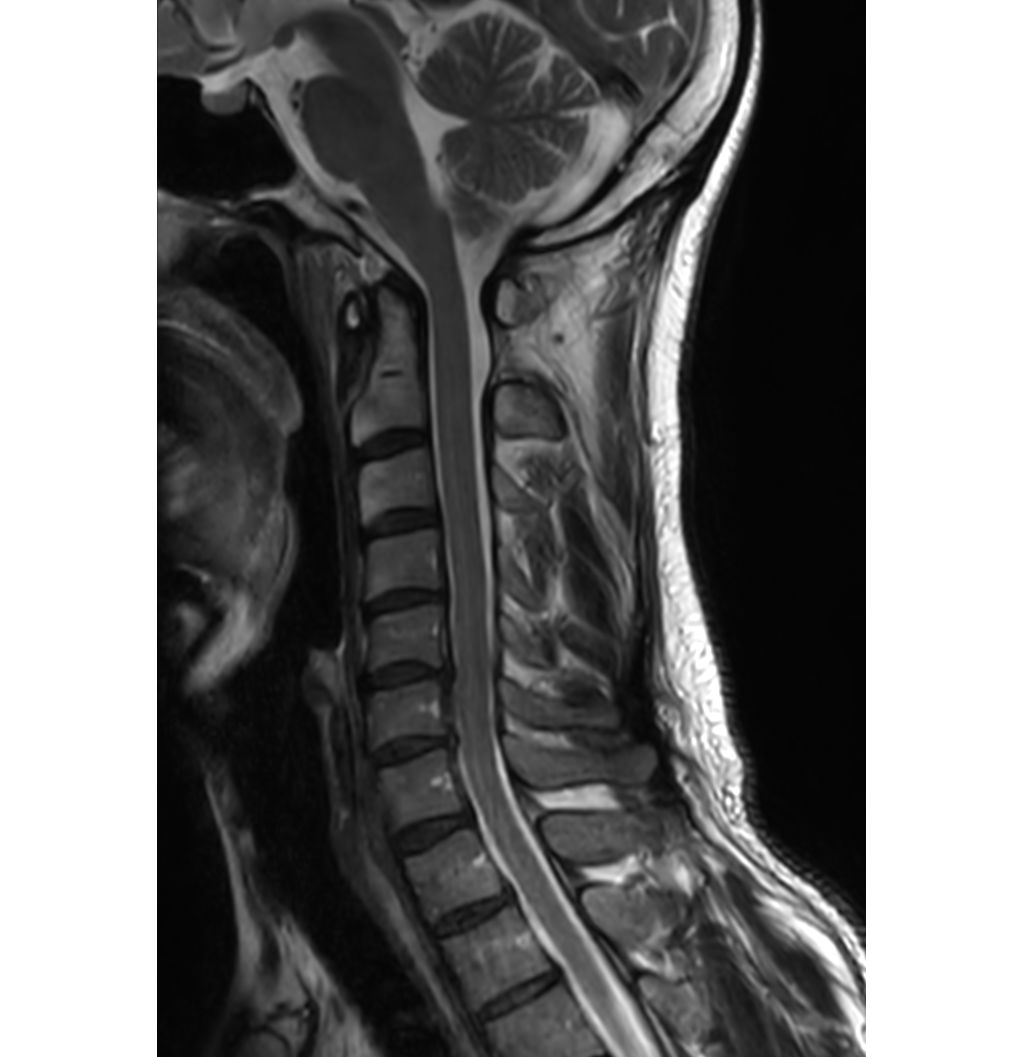 Sagittal T2w TSE 