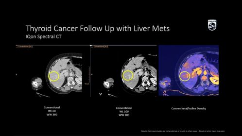 IQon Spectral Thyroid Cancer Follow Up with Liver Mets