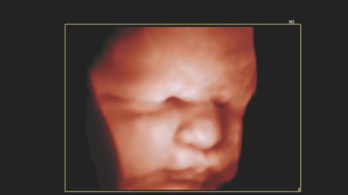 Fetal Face with TrueVue feature using a V6-2 transducer