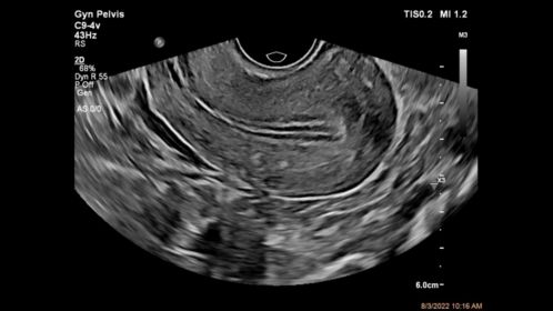 Gyn Pelvis ultrasound image shown using C9-4v transducer