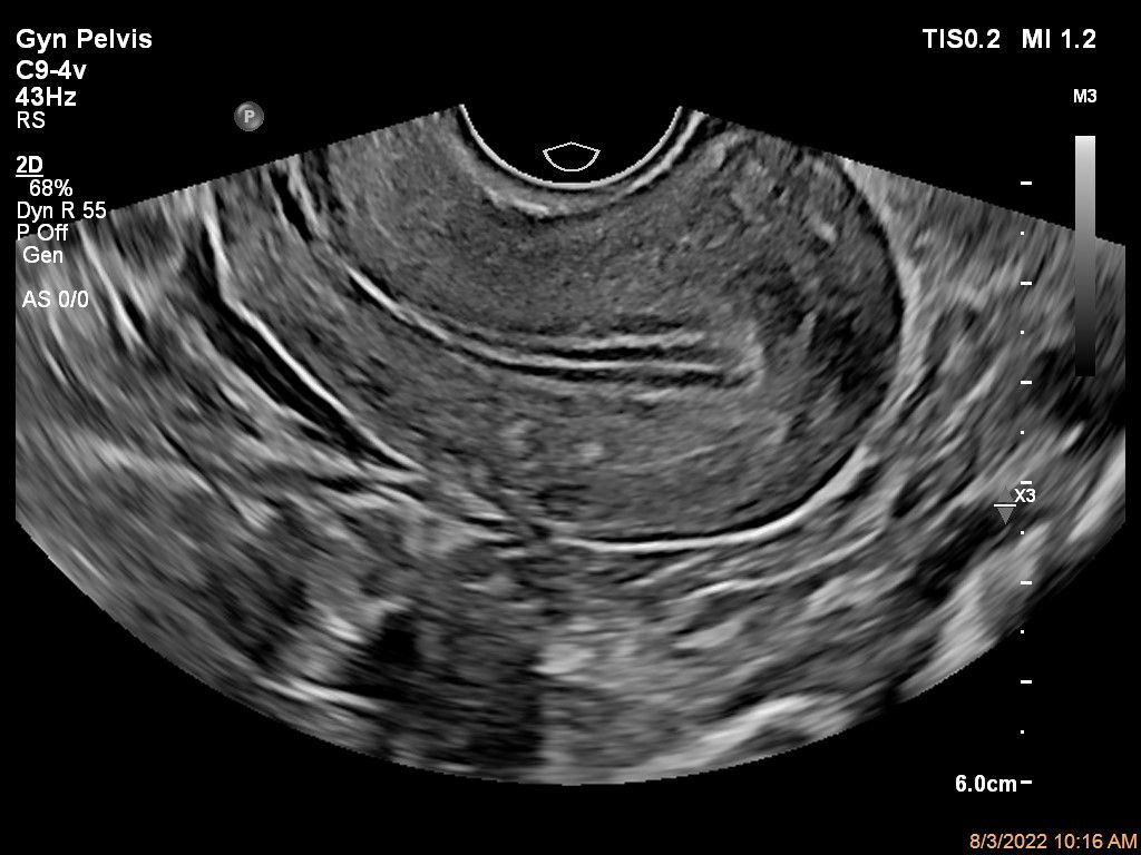 Gyn Pelvis ultrasound image shown using C9-4v transducer