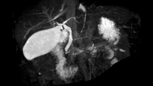 3D MRCP (MIP)