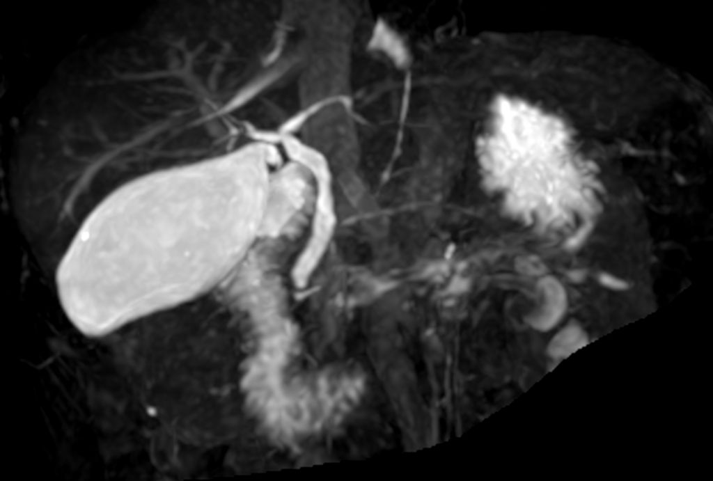 3D MRCP (MIP)