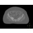 MRCAT Pelvis video thumbnail