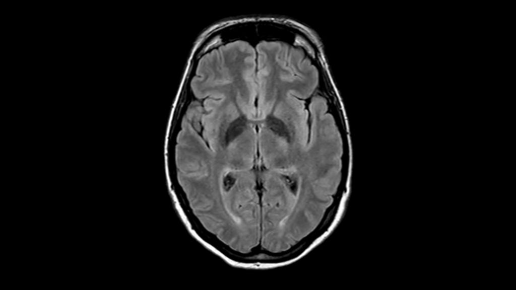T2w FLAIR clinical image of the brain